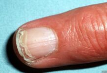 علت پوسته پوسته شدن ناخن 199009.jpeg alt_text