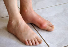 بیماری نقرس چه عوارضی دارد؟ 316776.jpeg alt_text