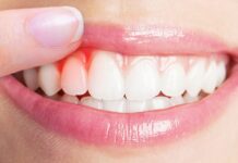 علت ورم لثه ها چیست؟ 360082.jpeg alt_text