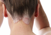 بیماری قارچی پوست سر چیست؟ 397202.jpeg alt_text
