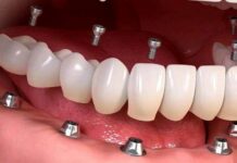 فواید و مضرات ایمپلنت دندان 467069.jpeg alt_text