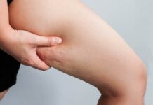 روش های درمان سلولیت 536189.jpeg alt_text