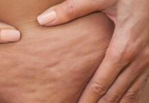 سلولیت چیست وبا چه علائمی در بدن ظاهر می شود؟ 598792.jpeg alt_text