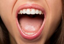 سرطان دهان ناشی از ویروس HPV 623288.jpeg alt_text