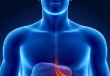 عوامل تشدید کننده ریفلاکس معده چیست؟ 694892.jpeg alt_text