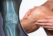 علل زانو درد در سنین مختلف 715421.jpeg alt_text