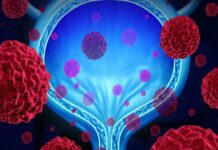 علائم سرطان مثانه علائم سرطان مثانه