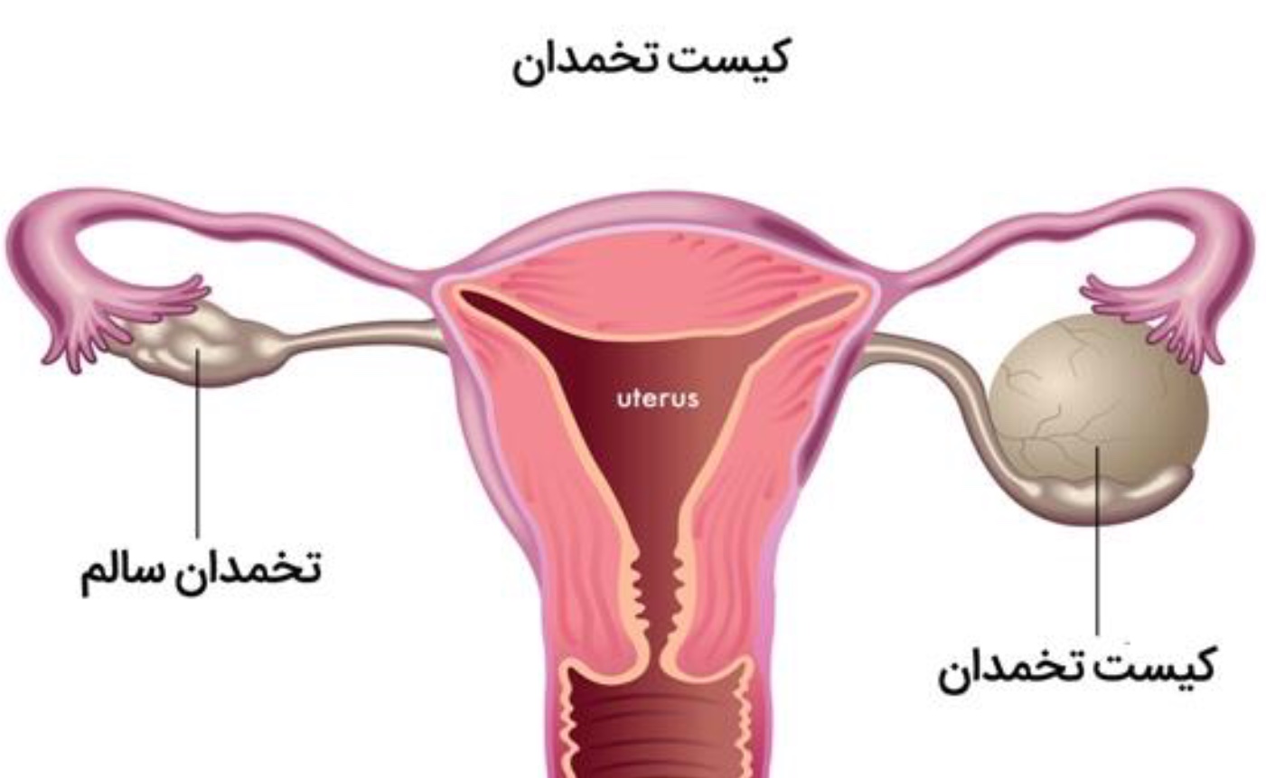 درمان گیاهی کیست تخمدان