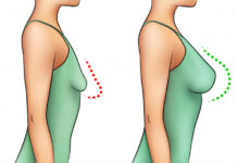 لیفت سینه و انواع آن لیفت سینه