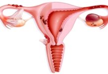 آندومتریوز و علائم آن آندومتریوز