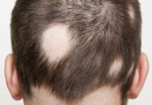 ریزش مو سکه ای چیست و چه دلایلی دارد؟ ریزش موی سکهای