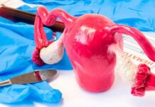 درمان فیبروم رحم درمان فیبروم رحم