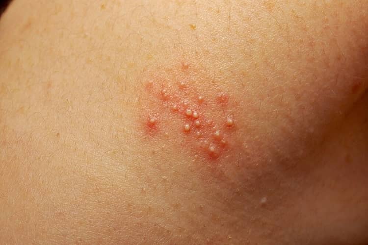 عرق سوز شدن و روشهای طبیعی برطرف کردن آن مجله پزشکی و سلامت طبینجا عرق سوز شدن و روشهای طبیعی برطرف کردن آن مجله پزشکی و سلامت طبینجا