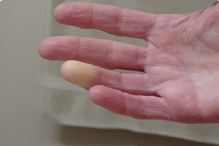 سفید شدن انگشتان دست