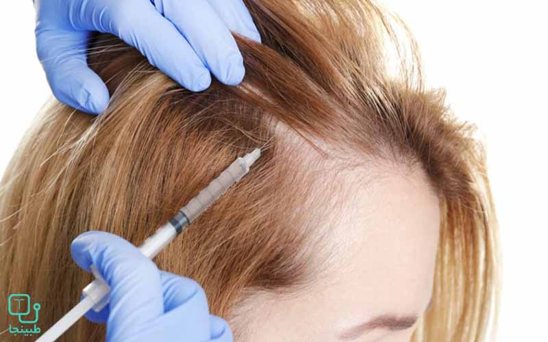 مزوتراپی برای درمان ریزش مو