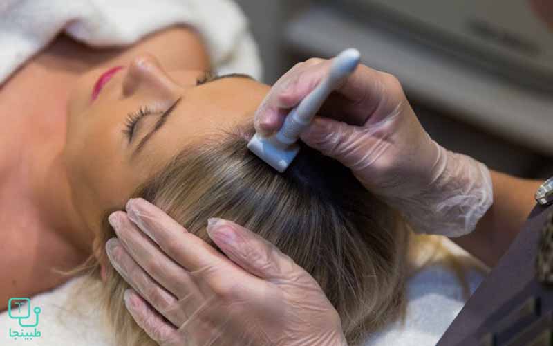 میکرونیدلینگ برای درمان ریزش مو