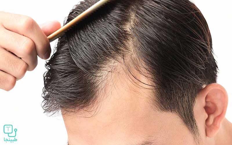علت نازک شدن مو در مردان